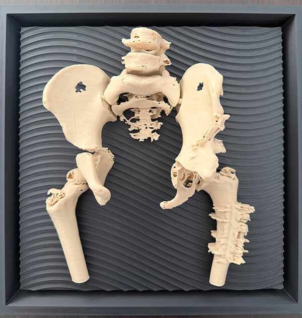 3D打印骨科解剖模型